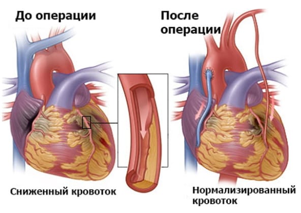 Аортокоронарное шунтирование в Бишкеке