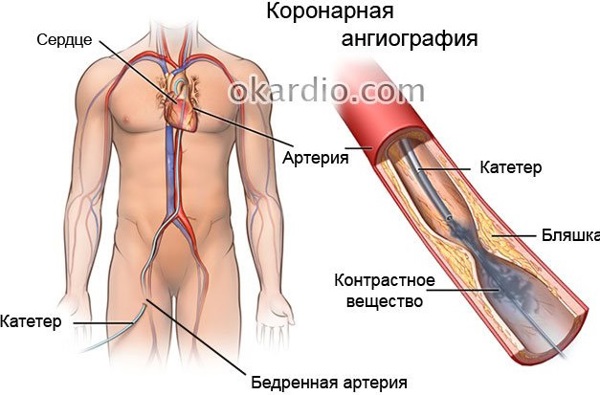 Коронарография сердца в Бишкеке