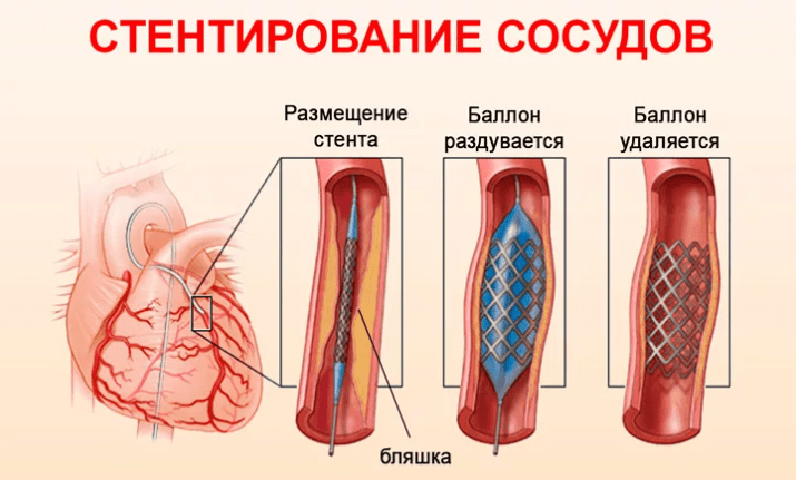 Стентирование сосудов в Бишкеке: современные методы, показания и особенности процедуры